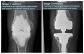 Restoring Functionality With Revision Knee Replacement