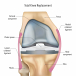 Knee Replacement Surgery Helps You Move and Feel Better
