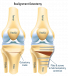 Osteotomy Surgery for Better Knee Balance