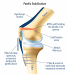 Patella Fracture Support for Safer Recovery