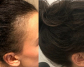 Hair Regrowth Treatment in Perth with Practical Care Plans