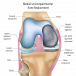 Move More Comfortably with Partial Knee Surgery