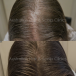 Personalised Hair Loss Treatment Solutions in Sydney