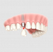 Restore Your Smile with Dental Implants in Bundoora