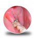 Best Wisdom Tooth Pain Extraction Services