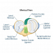 What Happens After a Knee Meniscal Tear Is Diagnosed
