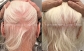 Regain Your Confidence with Best Androgenetic Alopecia Treatment